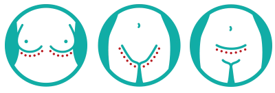 Kuvitus, joka näyttää yleiset käyttöalueet: rintojen alla, nivusissa ja ihopoimuissa.